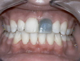 Internal whitening after re-root treatment