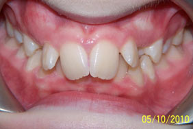 Malocclusion inherent or acute
