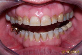 Tooth wear Abfractions Erosion Abrasion