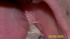 Treated surgical site