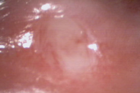 Oral Ulcer immediately after LLLT
