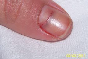 Fractured Nail, bleeding internally visible