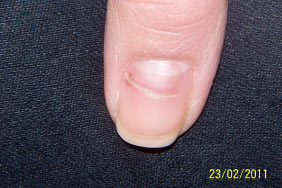 Weeks later no black nail